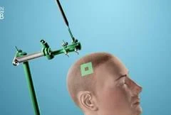 Sử dụng sóng siêu âm để chẩn đoán ung thư não