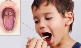 50% bệnh nhân bạch hầu không có triệu chứng