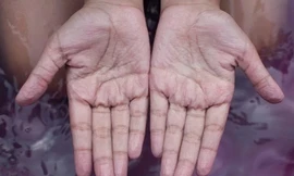 Lý do ngón tay bị nhăn khi ngâm nước