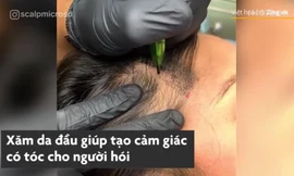 Xăm tóc cho người bị hói có giá 1.000 USD