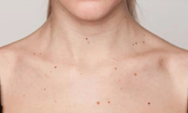 Nốt ruồi hình thành như thế nào?