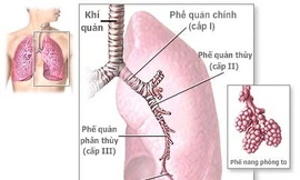 Hen phế quản có biến chứng thế nào?