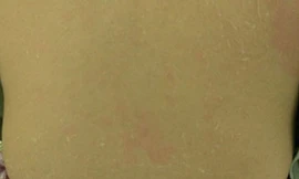 Tắm trắng tại nhà, cô gái bị 'lột da' loang lổ toàn thân