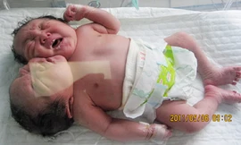 Bé gái có hai đầu, hai xương sống và 1,5 quả tim