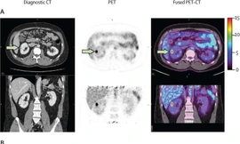 Phát hiện chính xác ung thư thận ác tính bằng kỹ thuật chụp ảnh mới