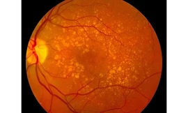 Uống bổ sung melatonin thường xuyên có thể làm giảm nguy cơ mù lòa khi về già 