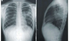 Tìm ra nguyên nhân vì sao nhiều người không bao giờ hút thuốc lá lại bị ung thư phổi