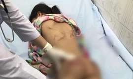Điều tra vụ bé gái bị chi chít vết thương khi ở với cô họ