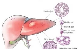 Công bố phát hiện quan trọng về bệnh ung thư gan