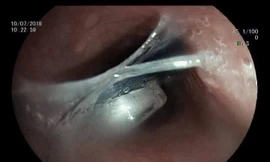 Người phụ nữ suýt chết vì 'chữa mẹo' lấy dị vật bị hóc