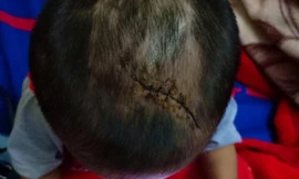 Bé trai 3 tuổi nghi bị mẹ ruột và cha dượng bạo hành dã man