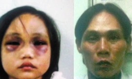 Bé gái 5 tuổi bị cha hành hạ tàn nhẫn