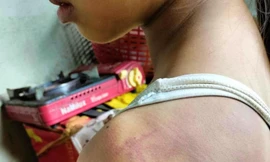 Nữ sinh lớp 4 bị 10 bạn cùng lớp đánh hội đồng bầm tím khắp người