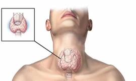 Dấu hiệu bất thường cảnh báo nguy cơ bị ung thư tuyến giáp, tuyệt đối không được bỏ qua