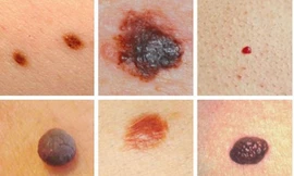 Những dấu hiệu dễ nhận thấy bằng mắt thường cảnh báo ung thư sớm, bạn không nên bỏ qua