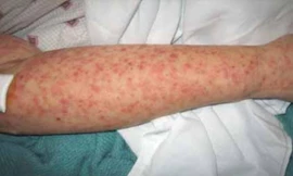 Ảnh minh họa: Bộ Y tế Campuchia