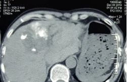 Cụ ông vỡ u gan, máu tràn ngập ổ bụng mà không hề biết