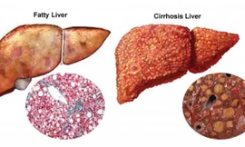 Những dấu hiệu cảnh báo gan có thể bị nhiễm độc, đi khám ngay kẻo 'muộn'