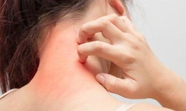 Ngứa da điên cuồng, có thể bạn đã mắc phải một trong các 'bệnh trọng' sau