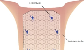 'Đoạn tuyệt' với sa sinh dục - bàng quang nhờ kỹ thuật nội soi hiện đại