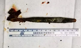  Chiếc bàn chải đã được lấy ra khỏi ổ bụng của Li. Ảnh: AsiaWire