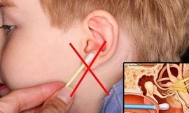 Những cách lấy ráy tai sai lầm có thể khiến bạn điếc vĩnh viễn