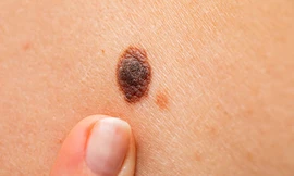 Nốt ruồi có dấu hiệu này nên đi khám ung thư 