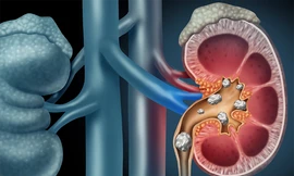 Thói quen tưởng vô hại nhưng lại là nguyên nhân khiến thận chứa cả ‘túi sỏi'