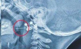 Bé gái 13 tháng bị dây thép đâm xuyên amidan vì lý do không ngờ