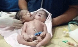 Cận cảnh đứa trẻ có 2 đầu 3 tay