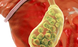 Chỉ đau lưng, người phụ nữ bất ngờ khi đi khám bác sĩ gắp ra 382 viên sỏi