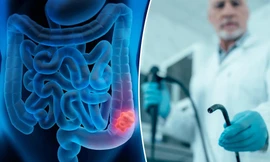 Nghiên cứu mới: Nội soi đại tràng có thể không hiệu quả như mong muốn 
