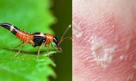 Nhận biết và xử lý tổn thương do độc tố từ kiến ba khoang