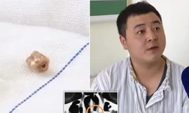 Chàng trai có răng trong mũi 20 năm không hề hay biết