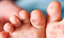 Mách mẹ cách bảo vệ bé yêu trước dịch chân tay miệng đang bùng phát