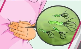 80% dân số Việt Nam nhiễm vi khuẩn HP trong đường tiêu hóa