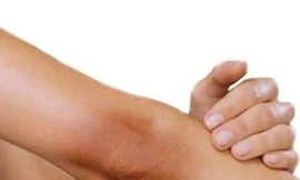 Cách trị vết thâm ở đầu gối và khuỷu tay 