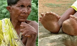 Người phụ nữ 63 năm sống với 19 ngón chân, 12 ngón tay