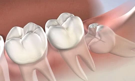 Tại sao con người có răng khôn?