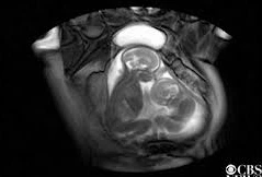 Video trẻ sinh đôi đá nhau giành chỗ trong bụng mẹ