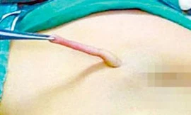 Bé 4 tháng tuổi mọc đuôi