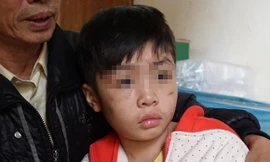 Cháu K. với nhiều vết sẹo trên mặt.