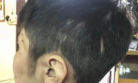 Trên khắp cơ thể bé K. (10 tuổi) chi chít những vết sẹo cũ lẫn mới chưa lành hẳn. Ảnh: Thanh Hà. 