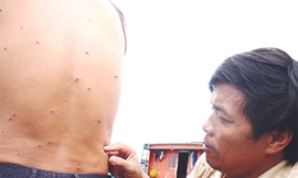 Lưng ngư dân Lê Quang Tư dính đầy vết đạn hoa cải