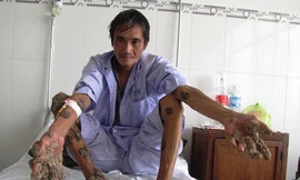 Người đàn ông mọc 'san hô' ở chân tay, dùng kéo tự cắt