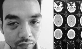 Đường Quang Anh đã bị một nhóm côn đồ dùng gậy chơi bi–a vụt khiến khuôn mặt bị biến dạng