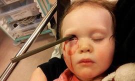 May mắn sống sót dù bị bút chì đâm vào đầu 4 cm