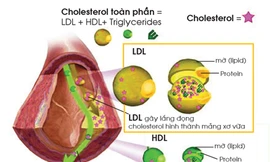 Rối loạn mỡ máu dẫn đến cơn đau thắt ngực