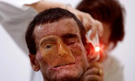 Anh Djalma Jardin bị hỏng một mắt vì bệnh lạ