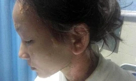 Cô gái tên Lin bị bồi bàn dội nước sôi lên đầu